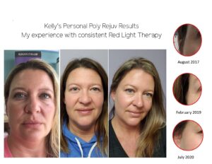 Kelly's personal Poly Rejuv red light therapy results at Sunsations in Topeka
